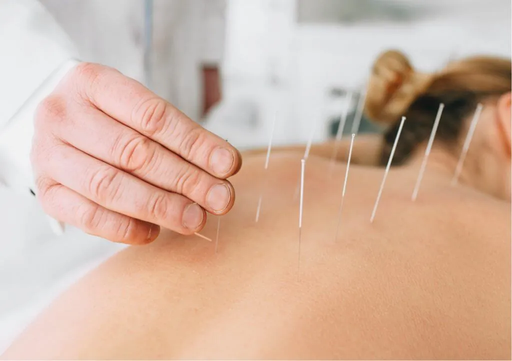 Patient testimonials on Arlington Physical Therapy's site featuring effective dry needling and cupping treatments.